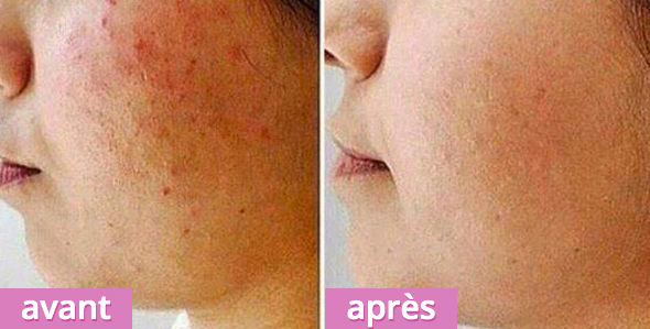 résultat brosse LR Zeitgard